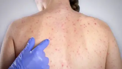 Sarampo em SP leva à ampliação da vacinação